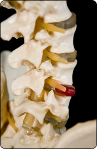 Back Pain and Ruptured Discs